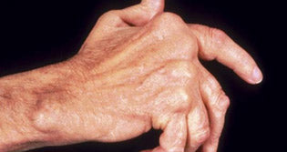Arthritis - Is there a cure?